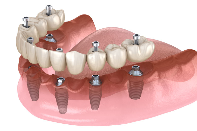 An image of full mouth dental implants in Chicago, IL.