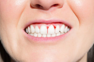 a dental patient showing her teeth and gums so she can be treated for periodontitis