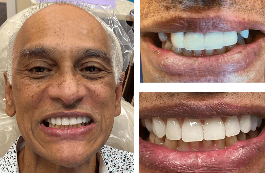 case 1 Full Arch Dental Implants singh