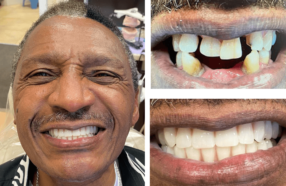 case 3 Full Arch Dental Implants singh