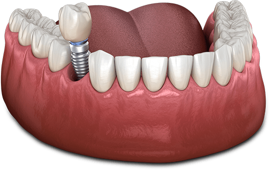 dental implants model