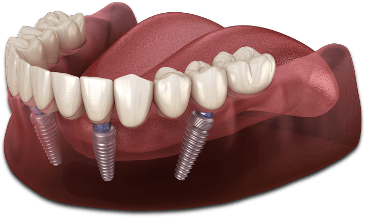 full arch dental implants model