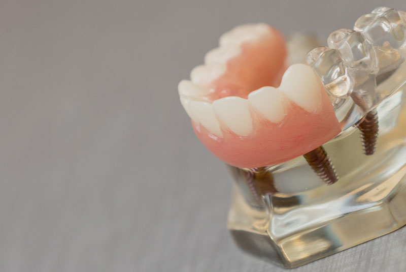 full arch dental model on counter