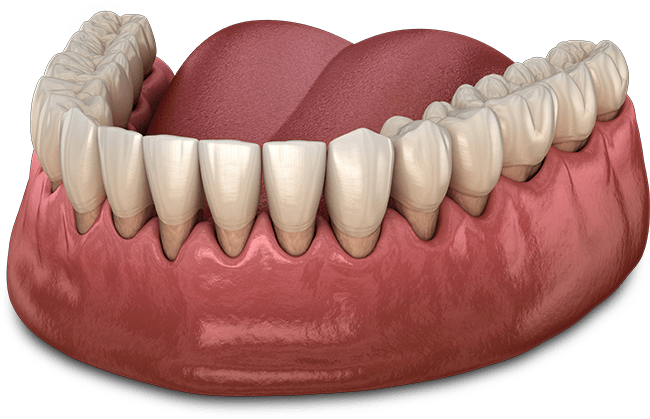 gum recession graphic