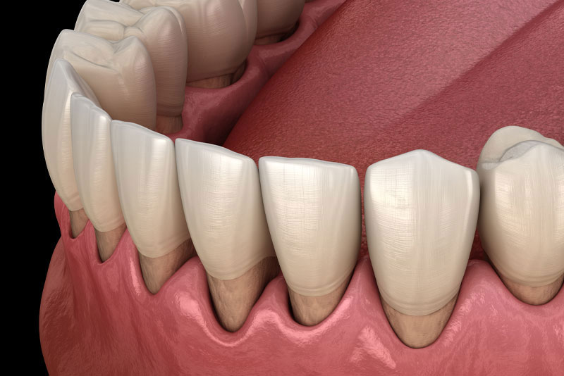 gum recession graphic