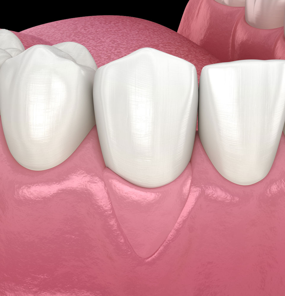 gums healthy after oseous surgery