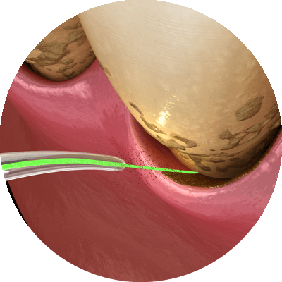 laser being used on gum tissue