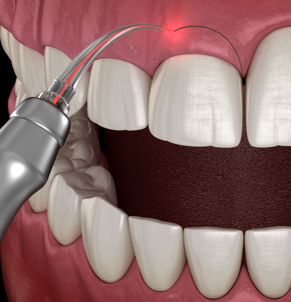 laser for crown lengthening