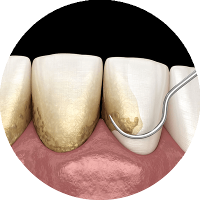 scaling and root planing dental procedure