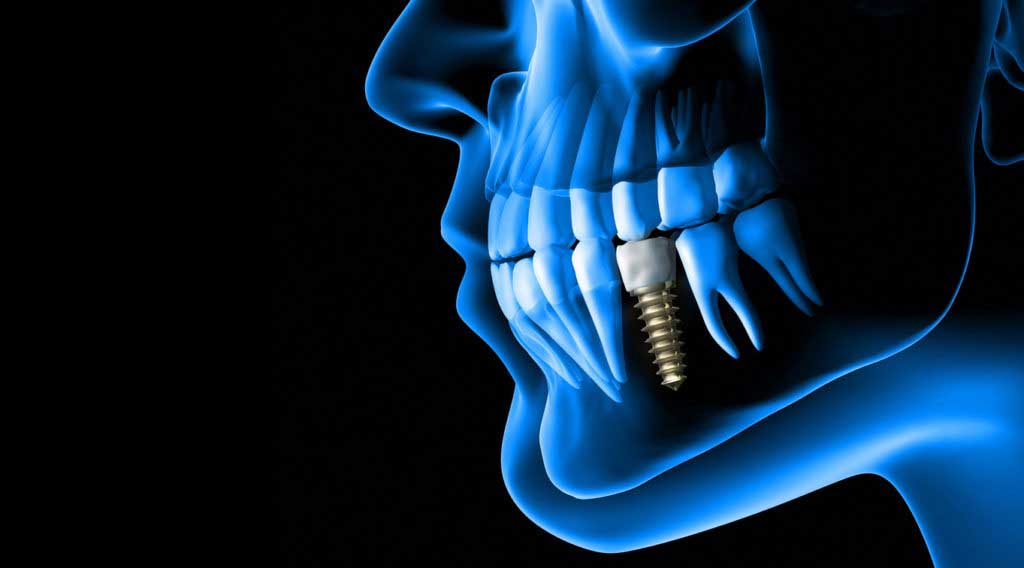 an x-ray view of a placed dental implant