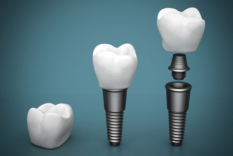 models of three types of dental implant options