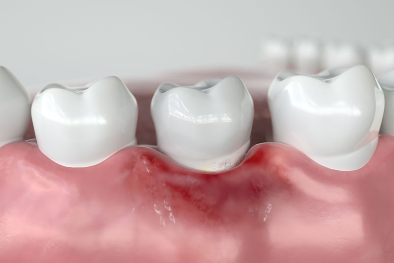 a picture of a lower arch gum disease model