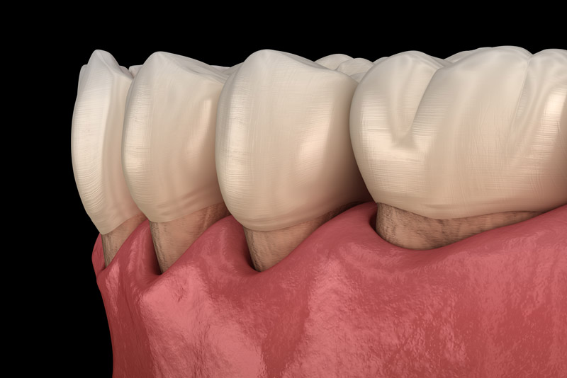 a close up of lower arch gums that have receded, exposing the teeth more.