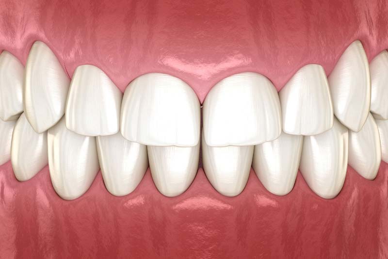 crown lengthening model