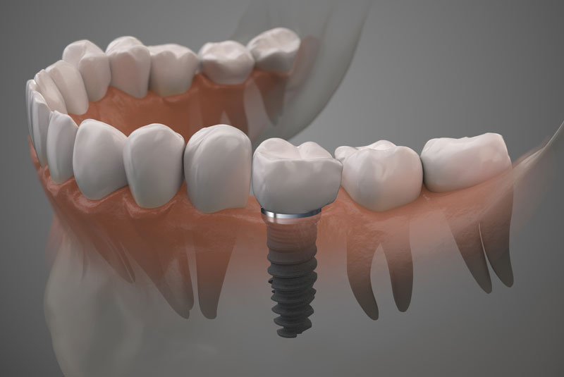 a single dental implant in a bottom jaw model.