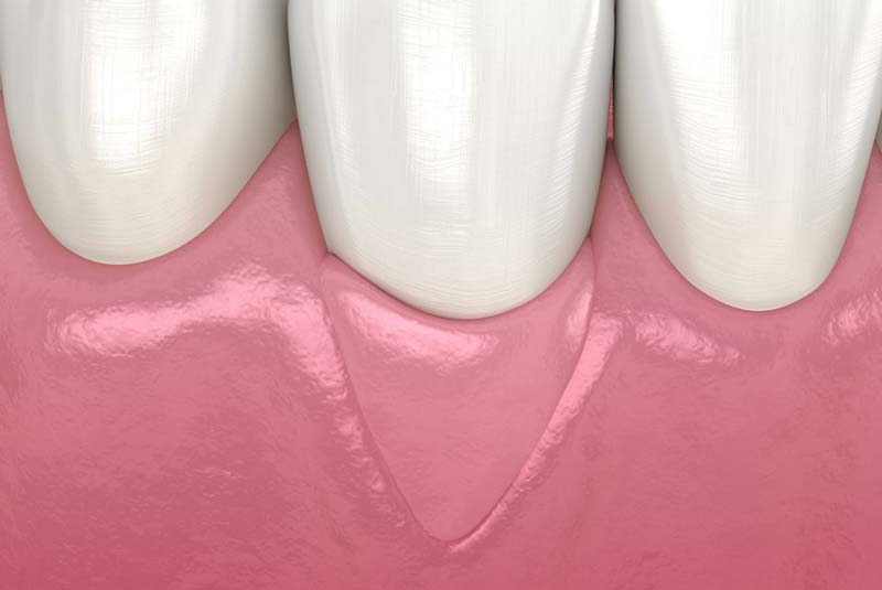 a model of a patient's gums after osseous surgery