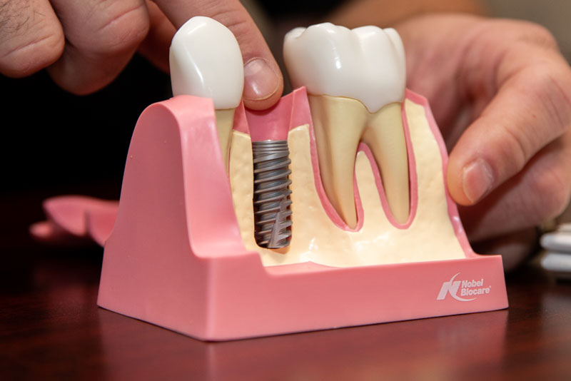 an image of a periodontist pointing at a dental implant model that shows the dental implant post in the gum line, next to a natural tooth.