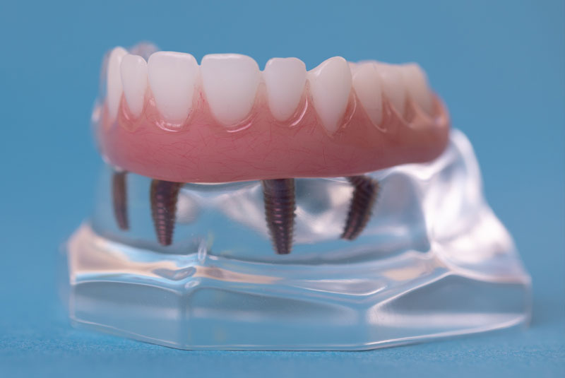 a model of full mouth dental implants