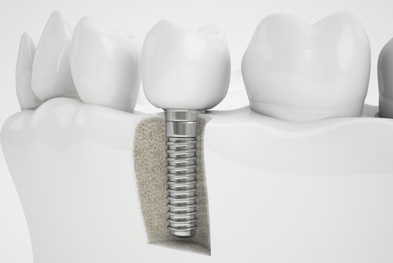 an image of a dental implant placed in the jawbone area where a bone grafting procedure has been done.