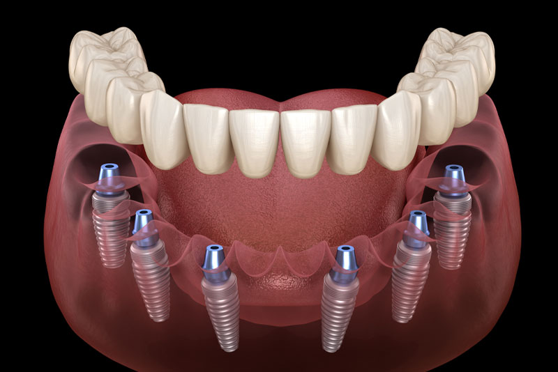 an image of a lower arch full mouth dental implant model that has four dental implant posts that can benefit a patients smile with its stability.