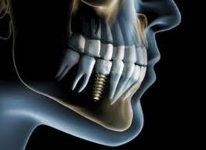 x-ray image of teeth and an example of a dental implant