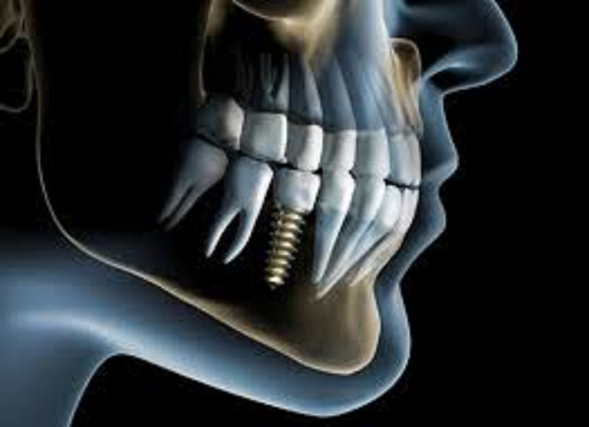 An image of dental implants 3D image model.