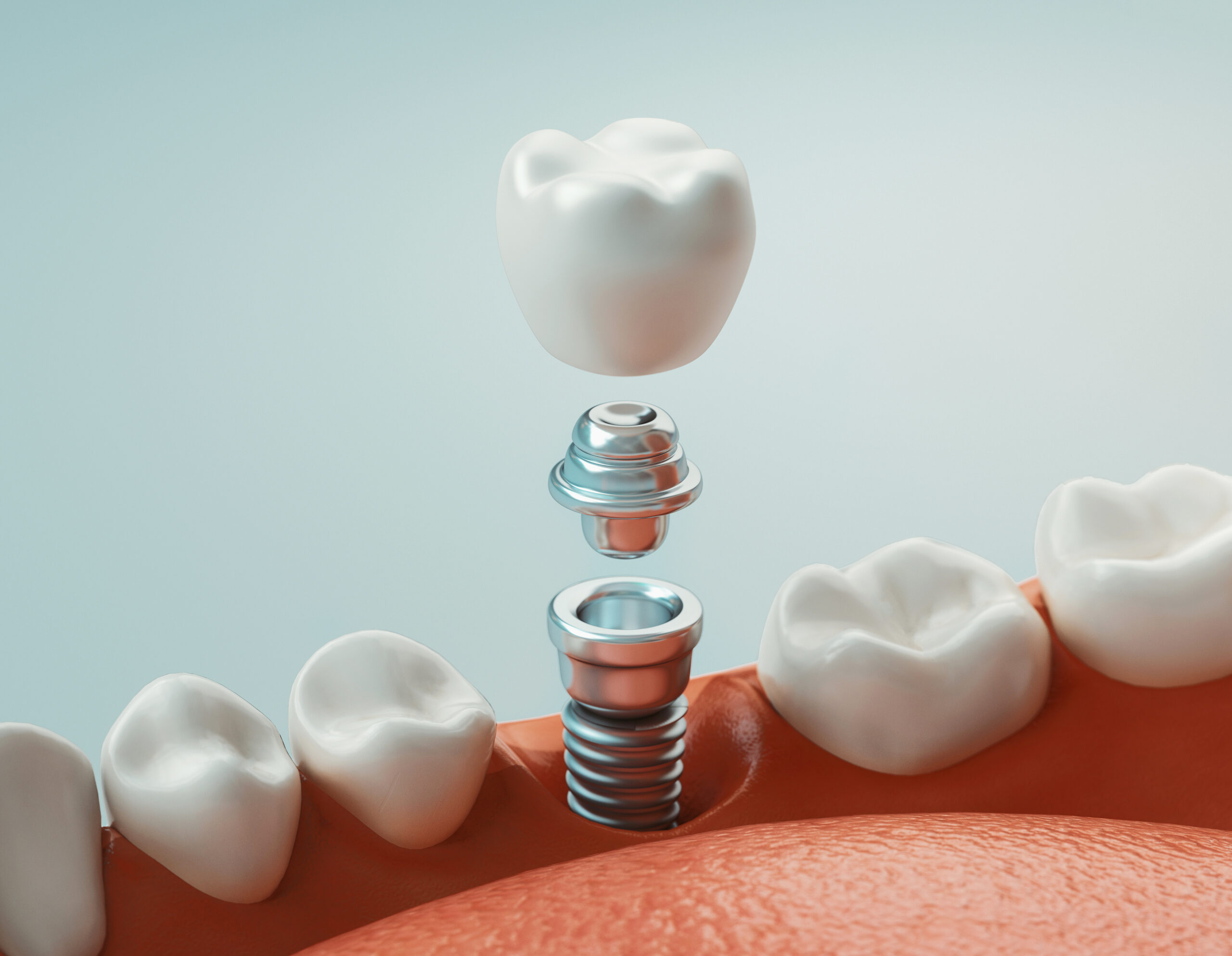 Dental care, dental implant, 3d rendering.