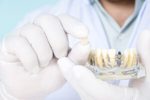 an implant dentist holding a dental implant crown and model.