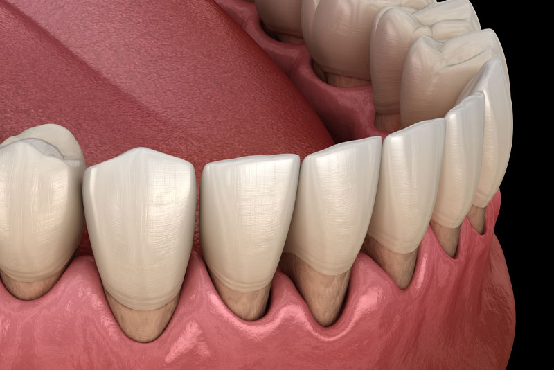 a graphic image of a lower arch of teeth that shows the areas of gum recession that can be treated with the chao pinhole surgical technique.