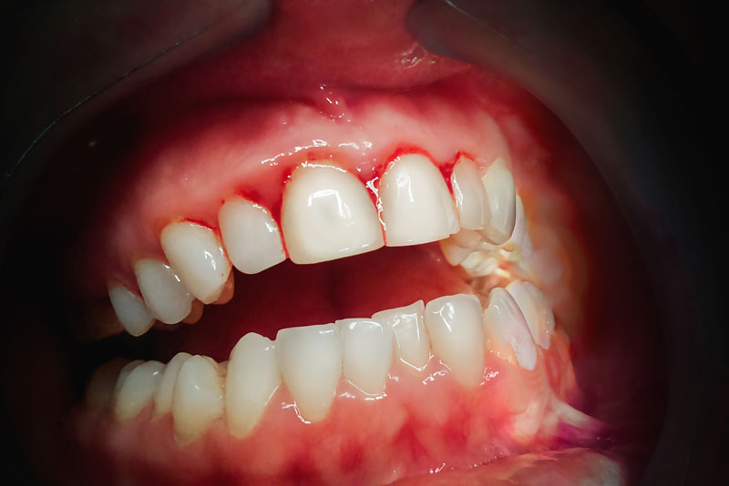dental patient with gum disease.