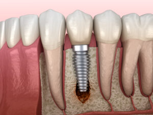 Periimplantitis with visible bone damage. Medically accurate 3D illustration.