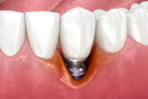 Peri-implantitis with visible gingiva recession. Medically accurate 3D illustration.