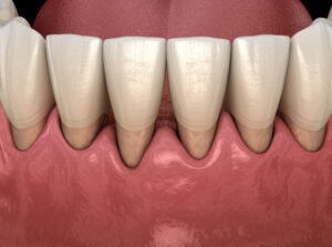 Gum recession process. Medically accurate 3D illustration.