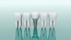 3d model of 4 teeth with a dental implant in the middle of them.