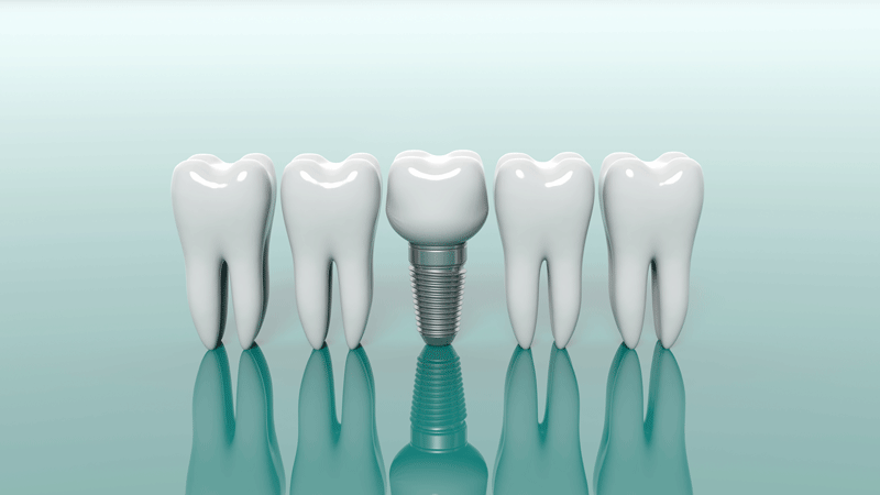 3d model of 4 teeth with a dental implant in the middle of them.