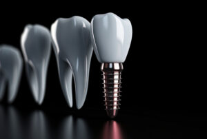 Digital model of a dental implant on a blacked out background.